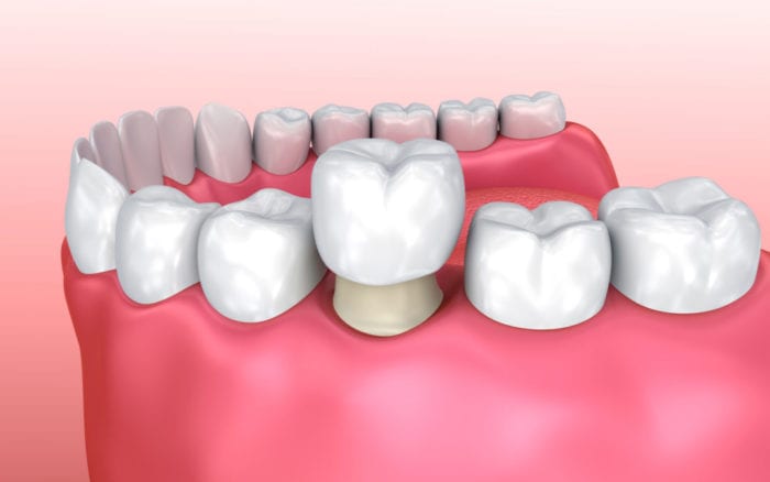 Tooth Crowns in Hartland, Michigan