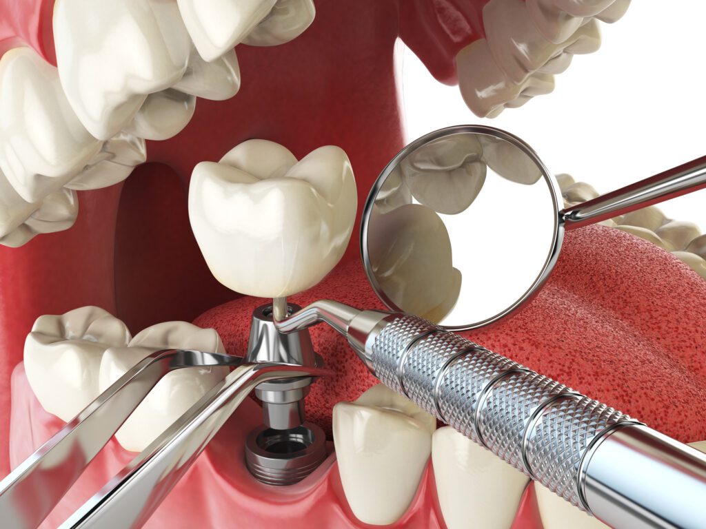 Dental Implants in Hartland, Michigan