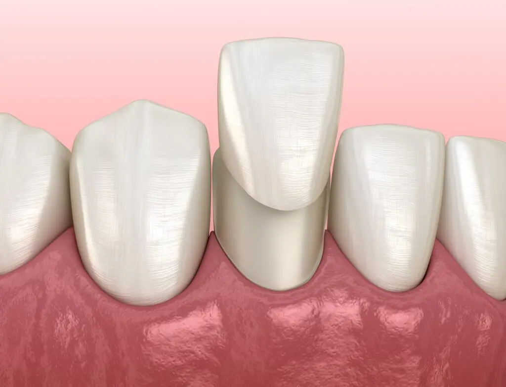 Porcelain Veneers in Hartland, Michigan