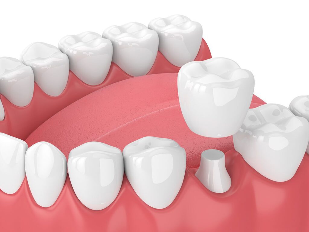 dental crown benefits Hartland Michigan