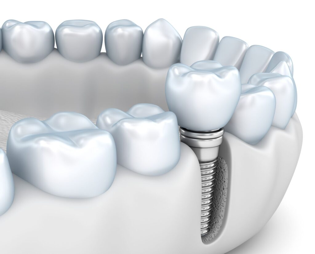 jawbone preservation with implant dentistry