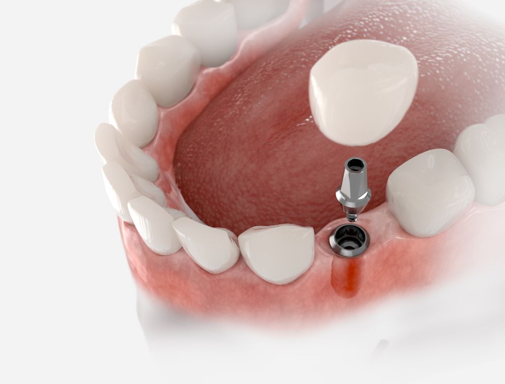 The Parts of a Dental Implant