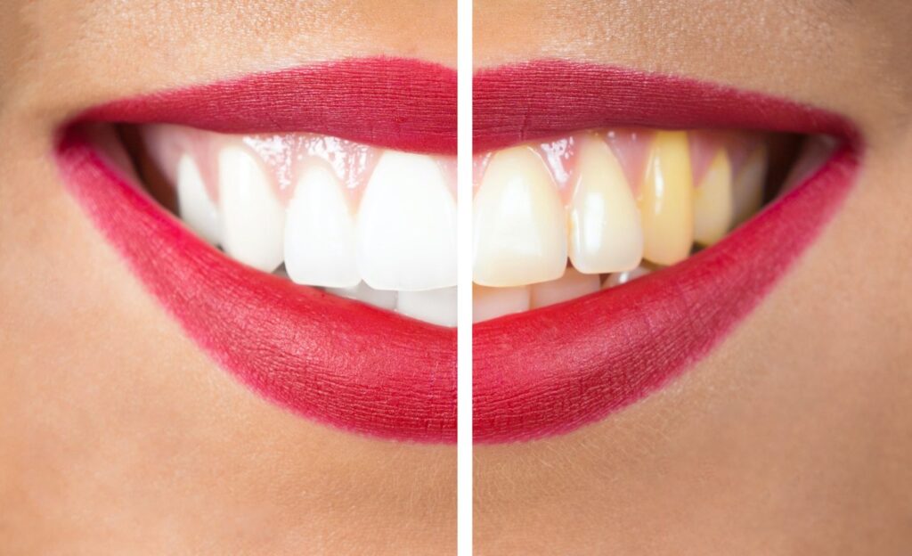 Examples of Dental Discoloration